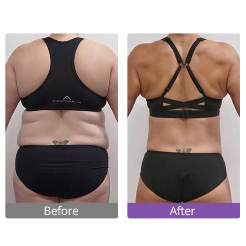 How about ultrasonic cavitation at home before and after？